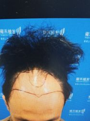 体验前-雍禾植发全国连锁