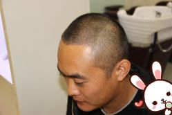 点击看大图 -大麦微针植发丨全国连锁