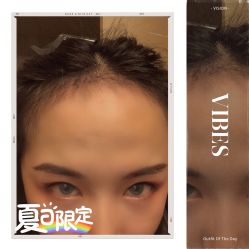 -大麦微针植发全国连锁