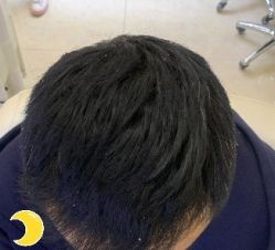 -大麦微针植发丨全国连锁