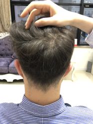 -大麦微针植发丨全国连锁