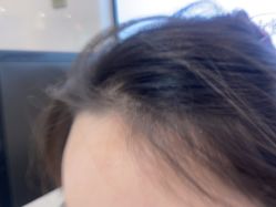 体验后-雍禾植发全国连锁