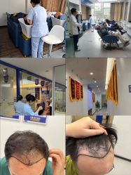 -大麦微针植发全国连锁