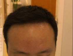 -大麦微针植发丨全国连锁