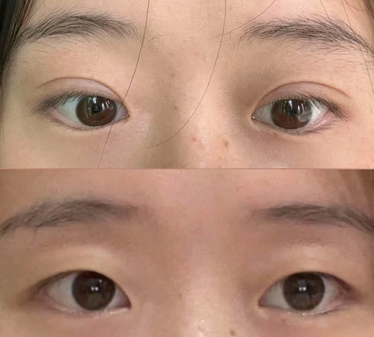 双眼皮的前后vs