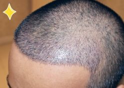 -大麦微针植发丨全国连锁