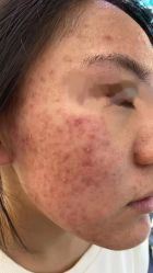 -瑶芳清颜草本祛痘