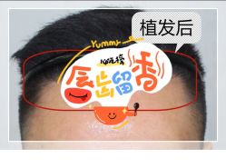 -大麦微针植发全国连锁