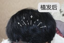-大麦微针植发全国连锁