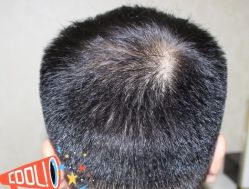 -大麦微针植发丨全国连锁