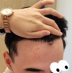 -大麦微针植发丨全国连锁