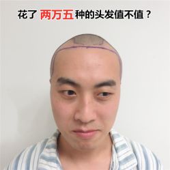 -碧莲盛·不剃发植发