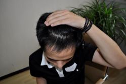 -大麦微针植发丨全国连锁