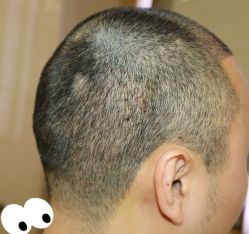 -大麦微针植发丨全国连锁