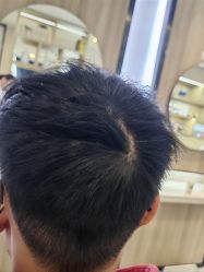 -大麦微针植发丨全国连锁