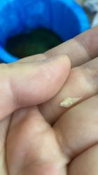 -德哥灰指甲脚气甲沟炎跖疣护理