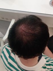 点击看大图 -碧莲盛·不剃发植发