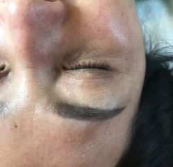 -美丽人生祛斑扁平疣汗管瘤中心