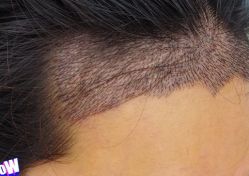 -大麦微针植发丨全国连锁