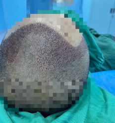 -大麦微针植发全国连锁