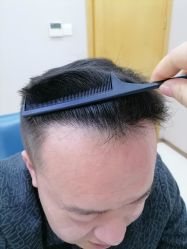 体验后-大麦微针植发丨全国连锁