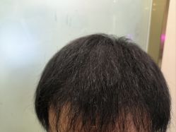 -碧莲盛·不剃发植发