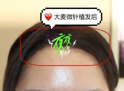 -大麦微针植发全国连锁