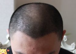 -大麦微针植发丨全国连锁