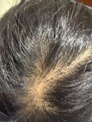 -碧莲盛·不剃发植发