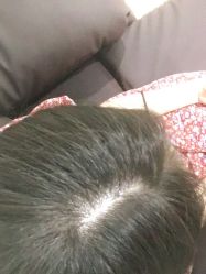 -碧莲盛·不剃发植发