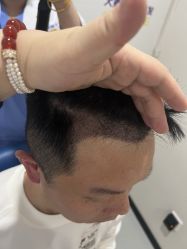 体验后-大麦微针植发全国连锁