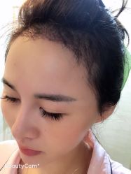 -大麦微针植发丨全国连锁