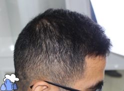 -大麦微针植发丨全国连锁