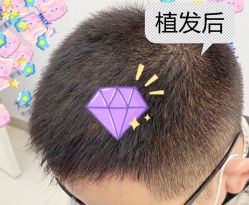 -大麦微针植发全国连锁