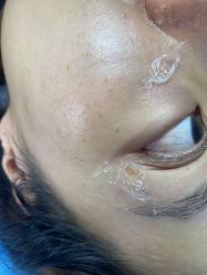 体验前-爱莎扁平疣·汗管瘤·斑痣中心
