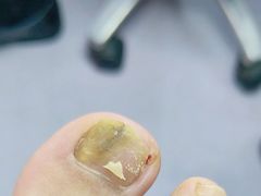 -祖传修脚甲沟炎灰指甲鸡眼