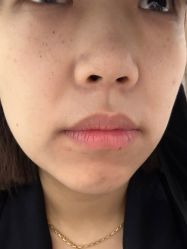 体验后-漾一医疗美容·面部抗衰中心