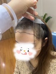 -大麦微针植发全国连锁