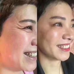 体验前-美安心医美·美迪迈黄金微针·美拉美医疗美容