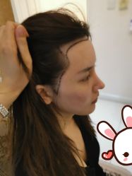 点击看大图 -大麦微针植发丨全国连锁