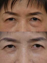 -广州健丽·去眼袋医疗美容机构