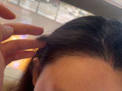 -碧莲盛·不剃发植发