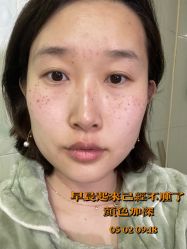 体验后-北京英煌医疗美容