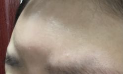 -海涛医疗美容·面部抗衰·注射美鼻