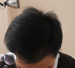 -大麦微针植发丨全国连锁