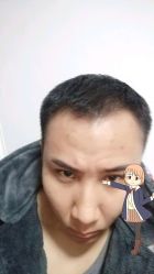 -大麦微针植发丨全国连锁