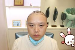 -大麦微针植发丨全国连锁