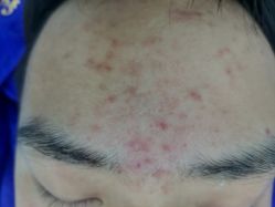 -蕾特恩专业祛痘国际连锁