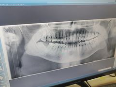 -上海仁爱医院口腔科 · 种植