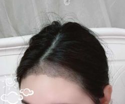 -大麦微针植发丨全国连锁